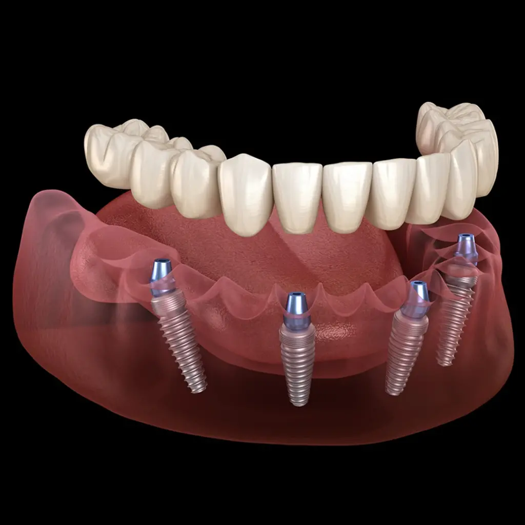 All On Four İmplant, All On Four Implant