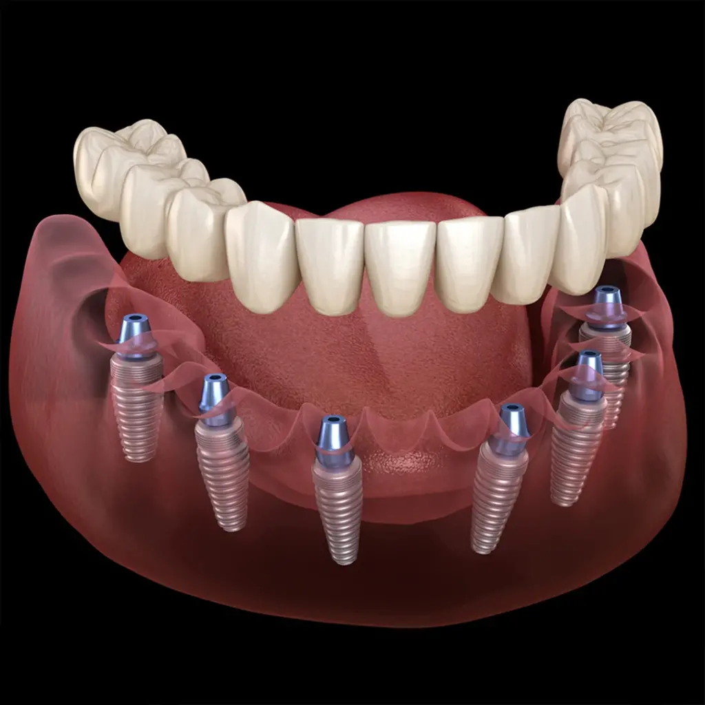 All On Six İmplant, All On Six Implant