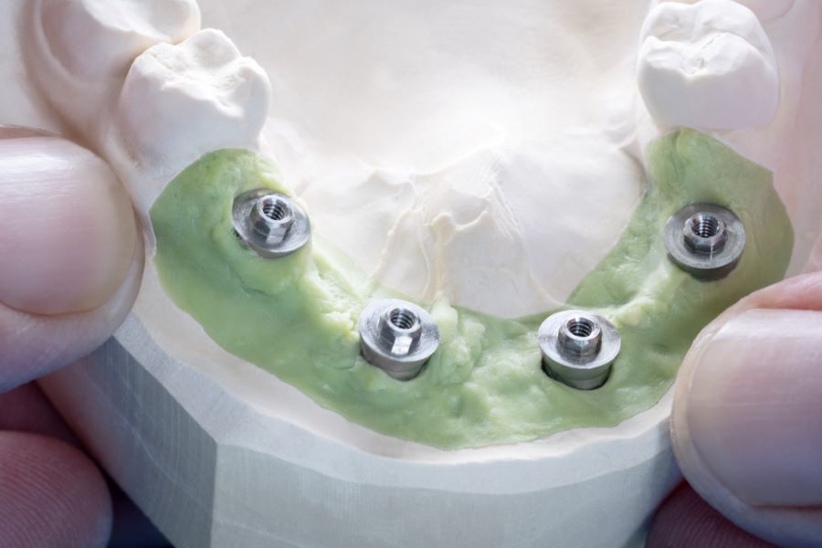 Abutment Nedir, Ne İşe Yarar?