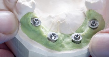Abutment Nedir, Ne İşe Yarar?