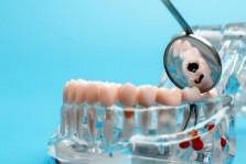 Diş Çürüğü ve Tedavisi