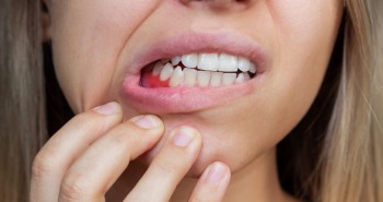 Diş Eti Çekilmesi (Periodontitis) Nedir? Nasıl Tedavi Edilir?