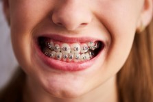 Diş Teli Kullananların Ağız Bakımında Dikkat Etmesi Gerekenler