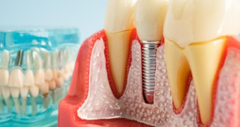 Periimplantitis (İmplant İltihabı) Nedir ?