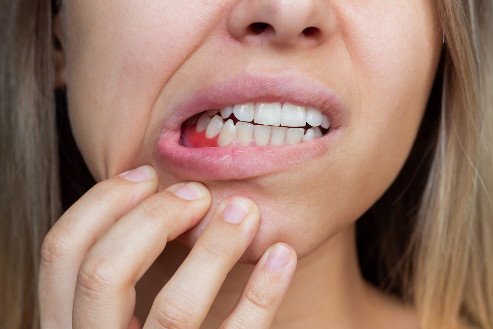 Diş Eti Çekilmesi (Periodontitis) Nedir? Nasıl Tedavi Edilir?